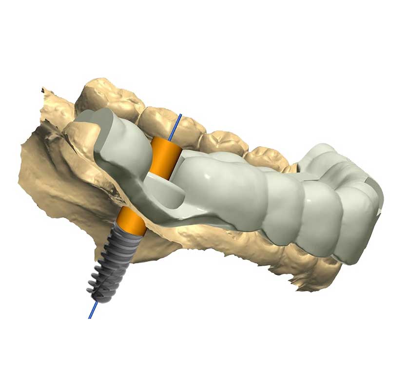 Advantages of 3D Guided Implant Surgery