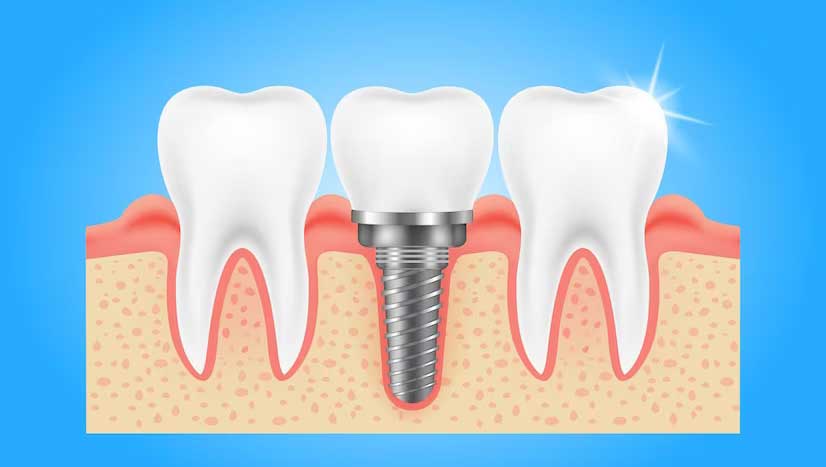 Why choose us for your Dental Implants?
