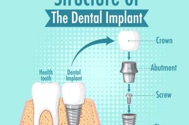 Understanding Tooth Implants
