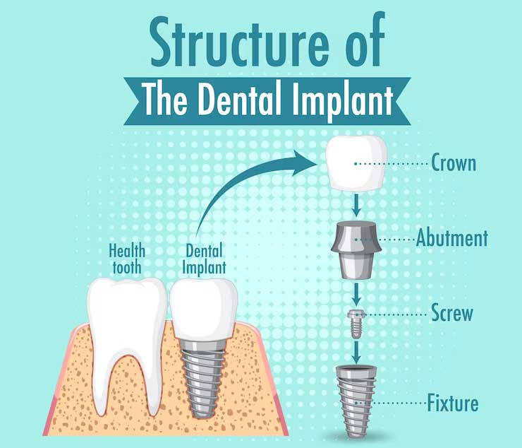 Understanding Tooth Implants