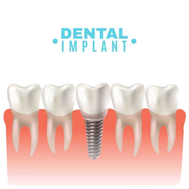 Tooth Implants in Dubai