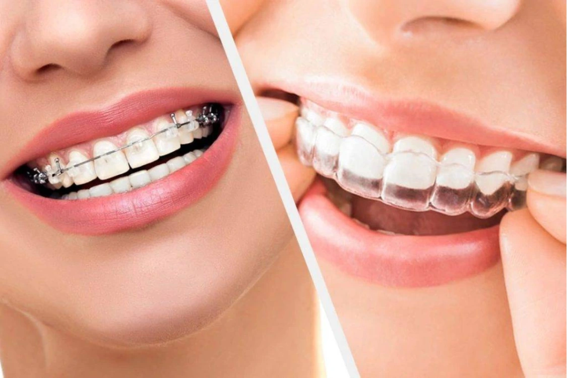 clear aligners vs braces