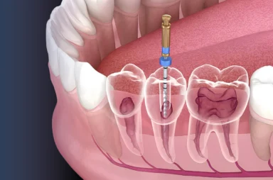 Cross-sectional illustration of a dentist cleaning infected root canals during endodontic treatment to preserve the natural tooth.