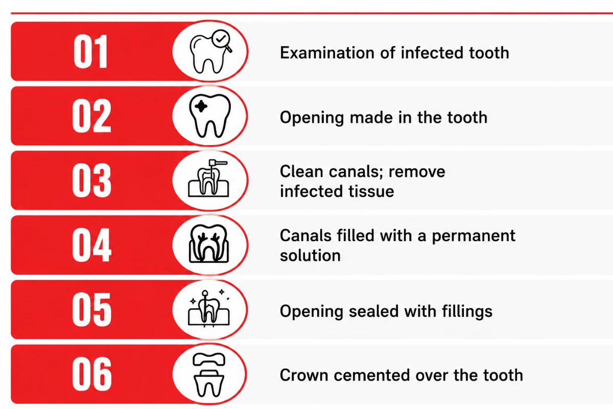 Infographic outlining the six stages of root canal treatment, from diagnosis and cleaning to sealing the tooth and fitting a dental crown.