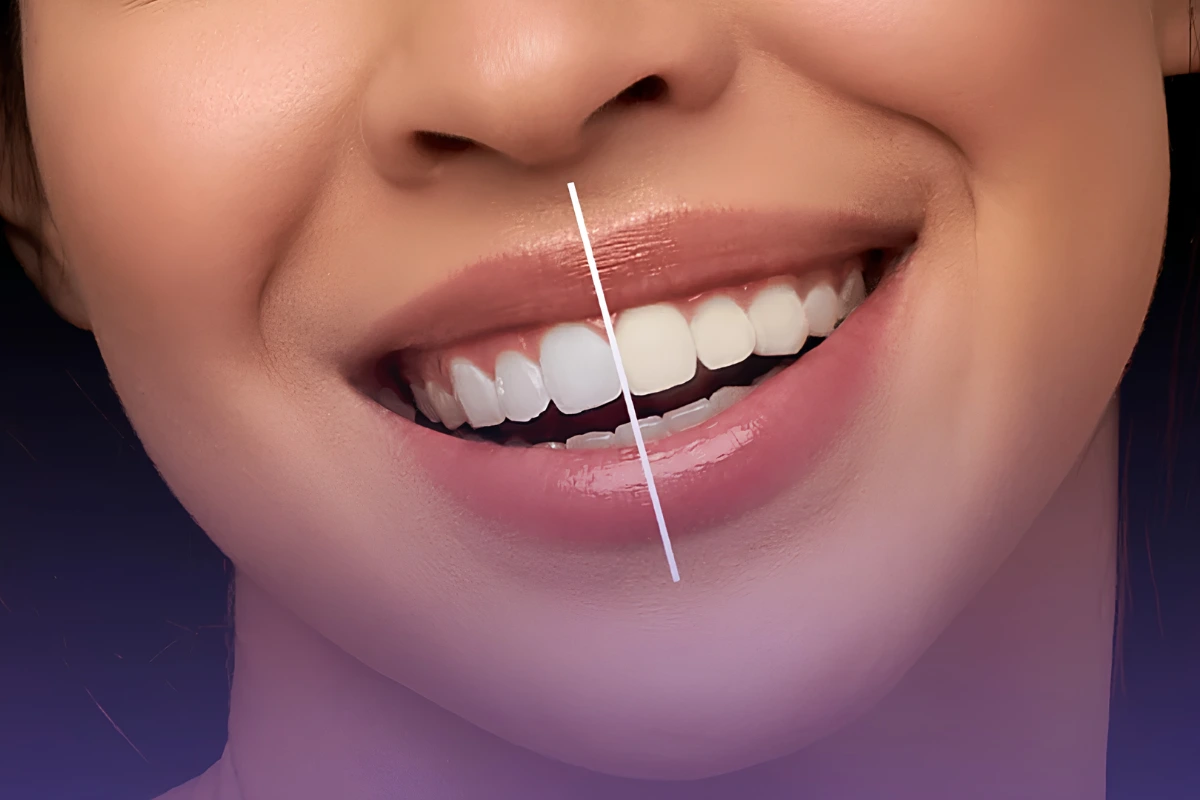 Before and after comparison showing professional teeth whitening results with a noticeably brighter smile.