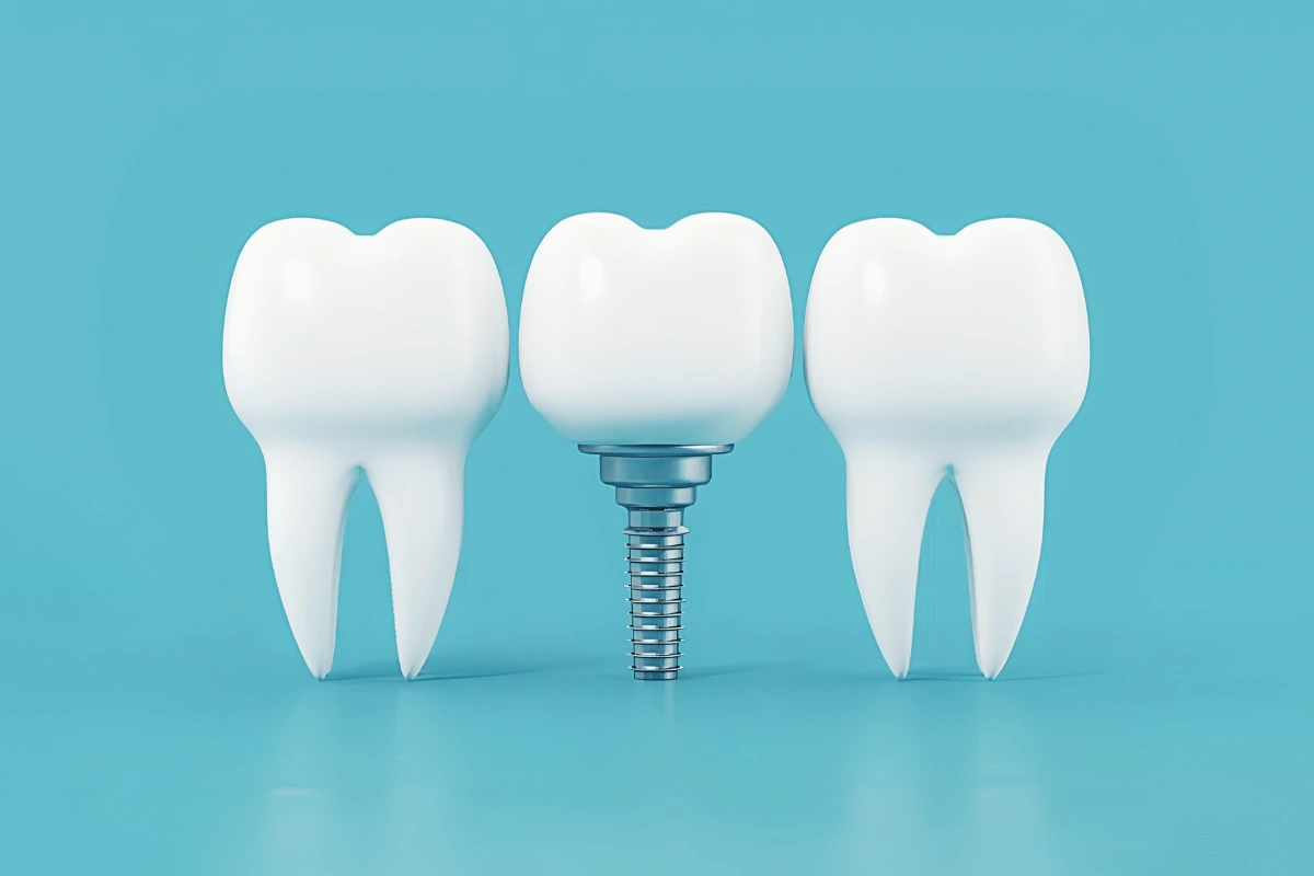 Illustration of a dental implant replacing a missing tooth between two natural teeth