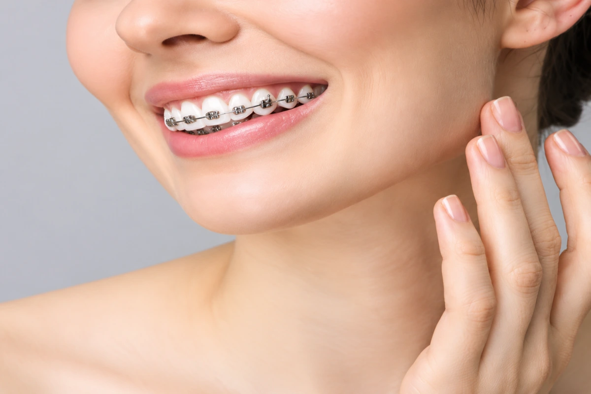 Close-up of a patient smiling with traditional metal braces on their teeth for orthodontic correction
